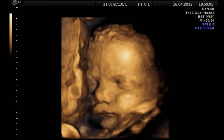 4D-Portraet eines ungeborenen Kindes im Mutterleib